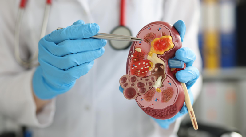 Cáncer de riñón: los síntomas silenciosos que pueden retrasar el diagnóstico Cáncer de riñón: los síntomas silenciosos que pueden retrasar el diagnóstico
